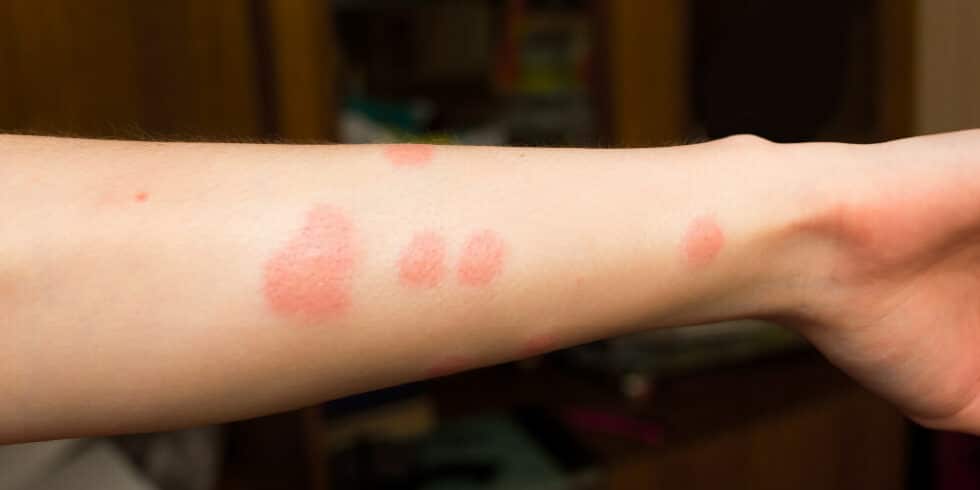 flea-bites-what-they-look-like-symptoms-treatment